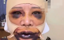 女子整容后肿成熊猫是怎么回事?详情介绍