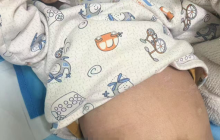 试管 婴儿出生不久确诊肾病综合征是怎么回事？详情介绍