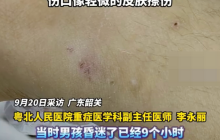广东小孩进ICU24小时后才知被蛇咬伤是怎么回事？详情介绍