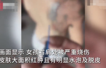 12岁哥哥用打火机电击洗澡4岁半妹妹致其烧伤