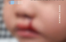 13岁女孩只吃肉不吃菜致淋巴结肿大：长期只吃炸鸡烤肠