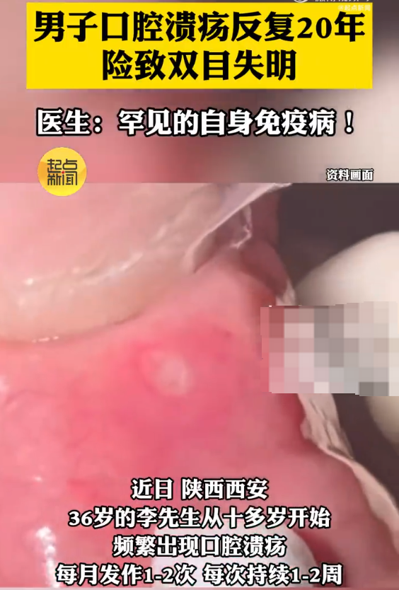 男子口腔溃疡反复20年险致双目失明 医生:罕见的自身免疫病! - php中文网