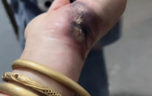 雨后充电要当心!女子被电伤手烧黑,金手镯瞬间熔断