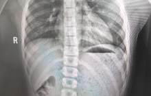 11岁男孩误吞10克金豆子,妈妈:我每天都提醒他不能在外面拉大便,这个大便有点贵