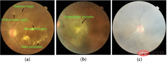 Deep ensemble learning algorithm for retinal image classification