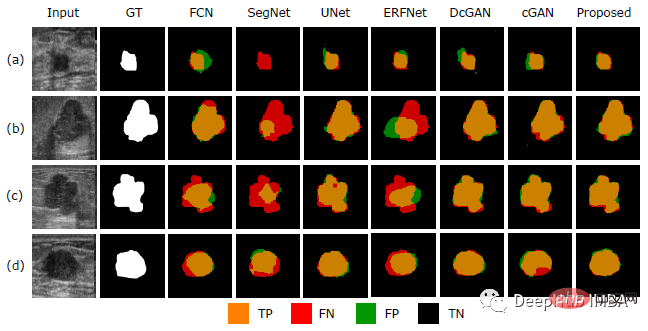 Recommended paper: Segmentation and classification of breast tumors in ultrasound images based on deep adversarial learning