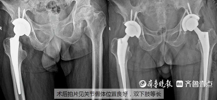 Das Tengzhou Central Peoples Hospital schließt den robotergestützten Hüftersatz ab