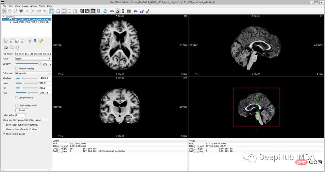 医学图像的深度学习的完整代码示例：使用Pytorch对MRI脑扫描的图像进行分割