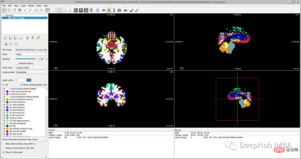 Full code example of deep learning for medical images: Segmenting images from MRI brain scans using Pytorch