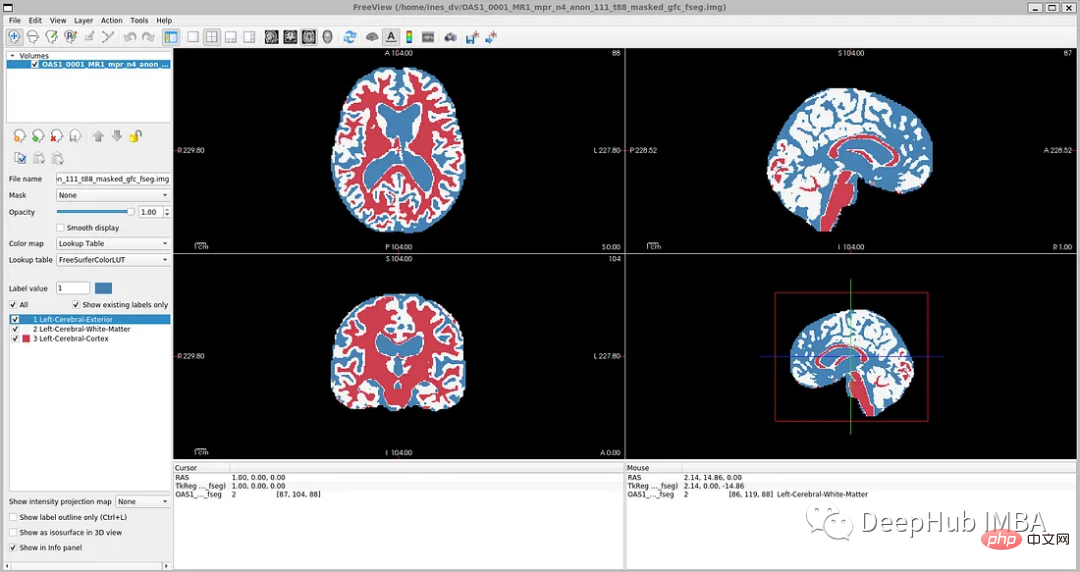 醫學影像的深度學習的完整程式碼範例：使用Pytorch對MRI腦掃描的影像進行分割