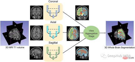 Full code example of deep learning for medical images: Segmenting images from MRI brain scans using Pytorch