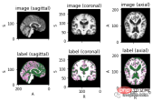 Full code example of deep learning for medical images: Segmenting images from MRI brain scans using Pytorch
