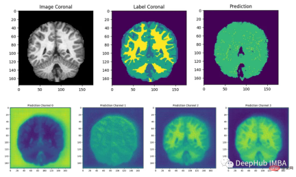 Full code example of deep learning for medical images: Segmenting images from MRI brain scans using Pytorch