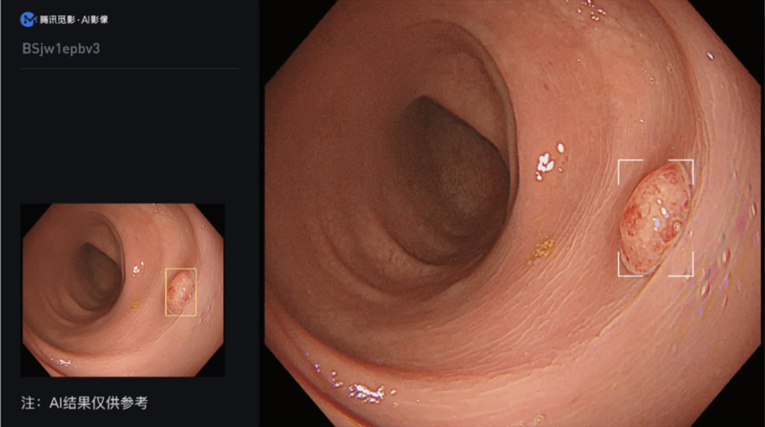 腾讯觅影结肠AI获批上市 助力结肠癌早发现
