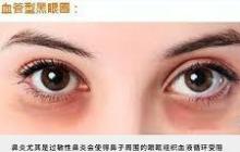 黑眼圈是因为睡眠不足吗