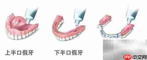 活动义齿优缺点及护理方法