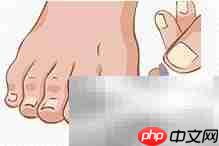 正甲贴:甲沟炎治疗新选择