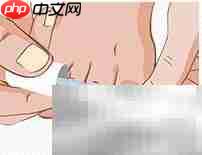 正甲贴:甲沟炎治疗新选择