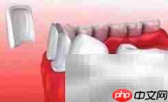 牙科常见修复方式一览