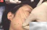 蛋白线提升多久见效?能维持多久?