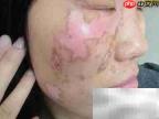 白点疯治愈周期揭秘