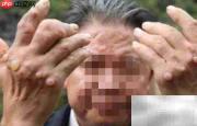 痛风高发人群有哪些?