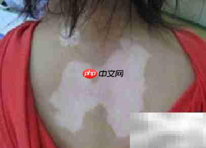 冬季白癜风饮食调理指南