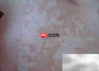 冬季白癜风饮食调理指南