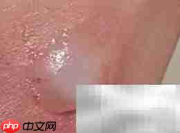 氢气球爆炸受伤如何急救