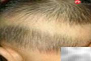 宝贝缺钙的5大症状