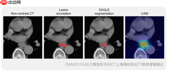 阿里达摩院发布食管癌 ai 模型 damo eagle:不插管,平扫 ct 就能查早癌