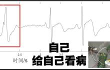 工程师生病了怎么办？自己做电路给自己测：ECG与心脏早搏