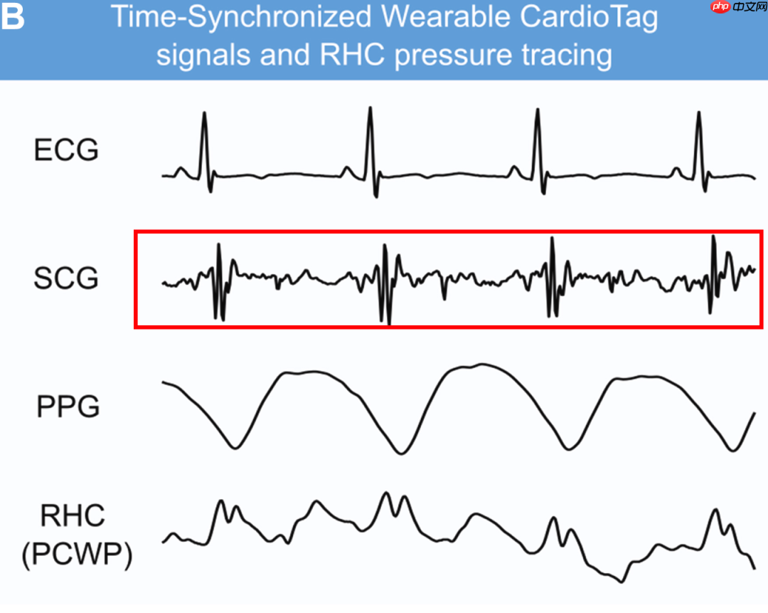 创新医疗新参数-SCG（心震图）：详细解读版