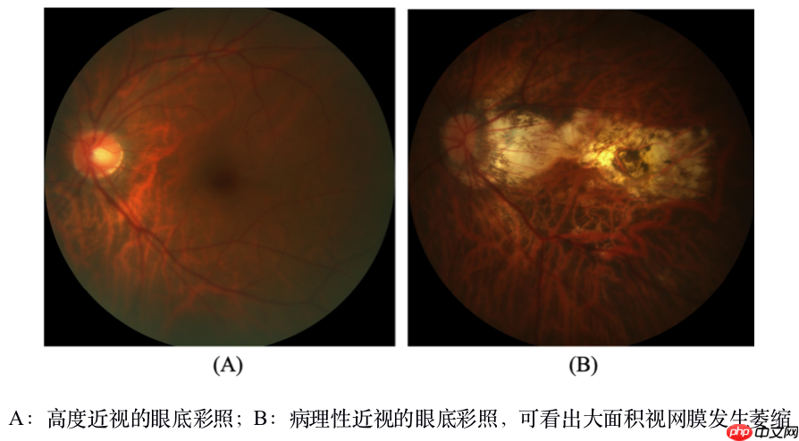 飞桨常规赛：PALM眼底彩照视盘探测与分割 2021 5月第1名方案 - php中文网