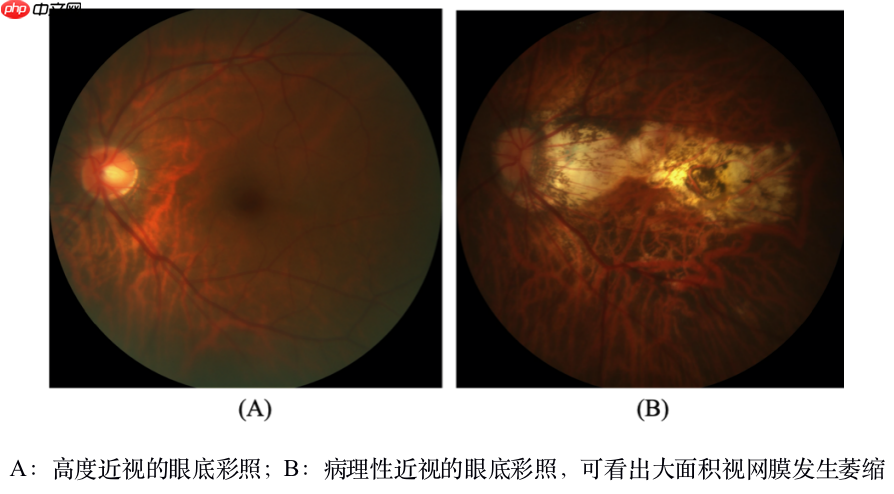 飞桨常规赛：PALM眼底彩照视盘探测与分割 - 8月第2名方案 - php中文网