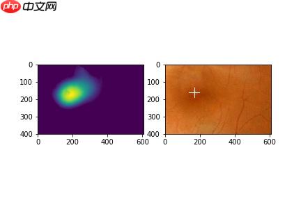 【飞桨常规赛】GAMMA中央凹检测 11月第2名方案 - php中文网