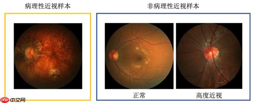 PaddleX超简单之--【常规赛：PALM病理性近视预测】第二名方案 - php中文网