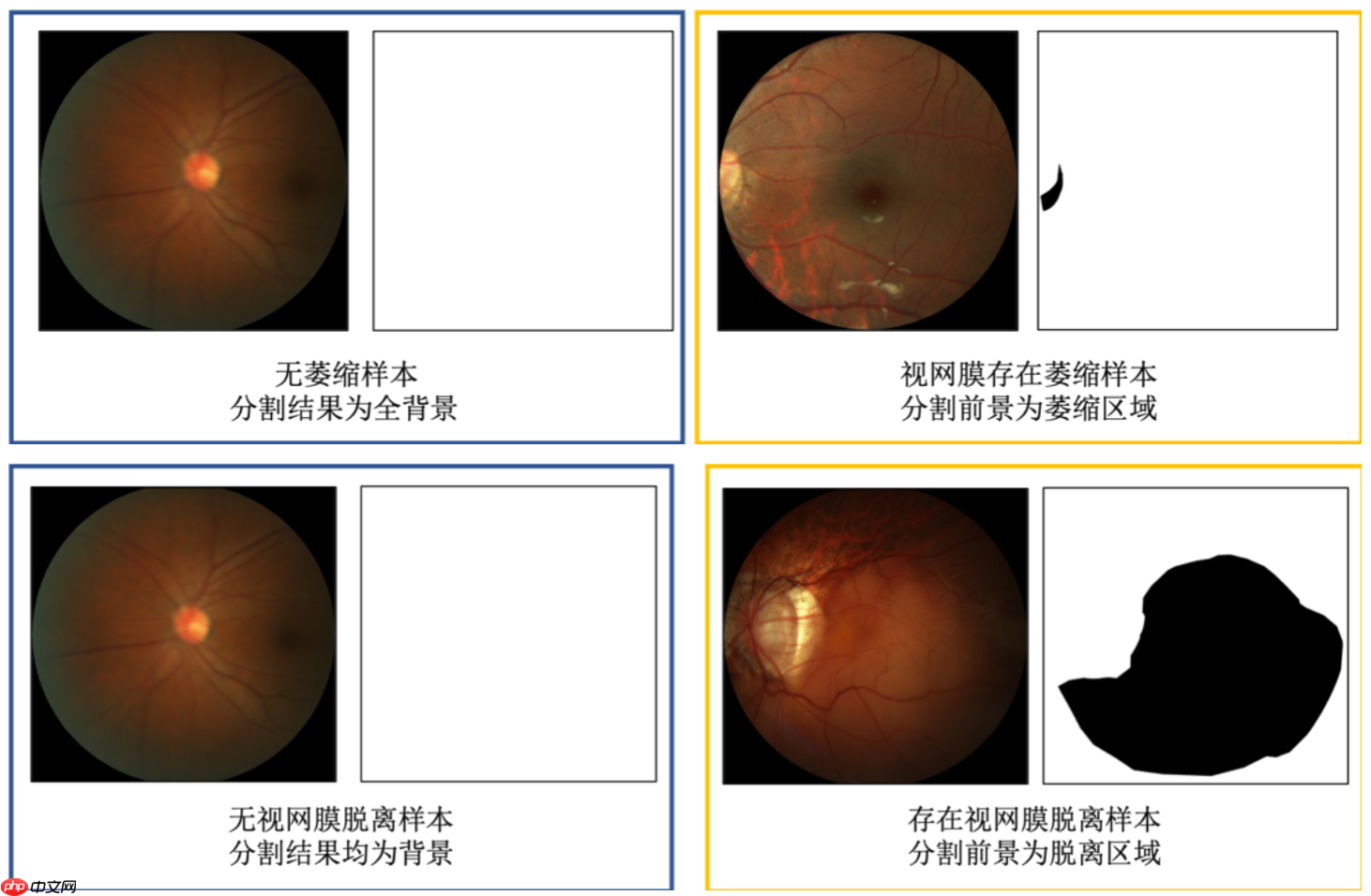 飞桨常规赛:PALM病理性近视病灶检测与分割 - 5月第六名方案 - php中文网
