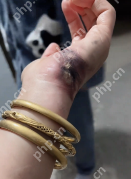 雨后充电要当心！女子被电伤手烧黑，金手镯瞬间熔断 - php中文网