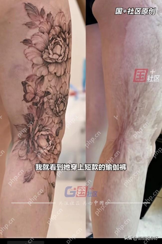 女子用文身遮住燙傷疤痕重拾自信 詳細介紹 - php中文網(wǎng)