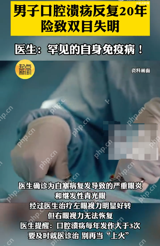 男子口腔溃疡反复20年险致双目失明 医生:罕见的自身免疫病! - php中文网