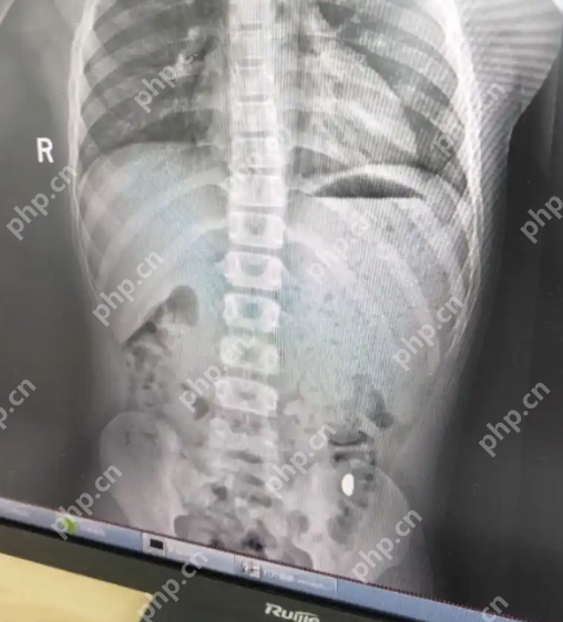 11岁男孩误吞10克重金豆,妈妈:天天叮嘱他不要在外面上厕所,有点贵 - php中文网