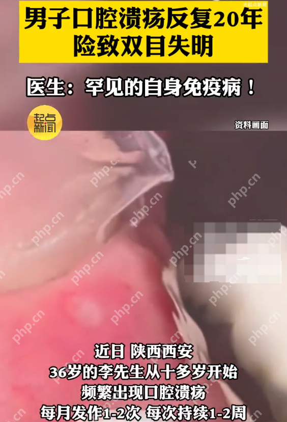 男子口腔溃疡反复20年险致双目失明 医生:罕见的自身免疫病! - php中文网